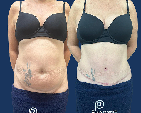 Abdominoplastia 01