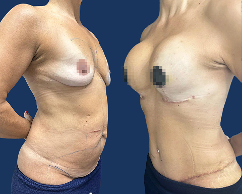 Mastopexia com Prótese e Abdominoplastia 01