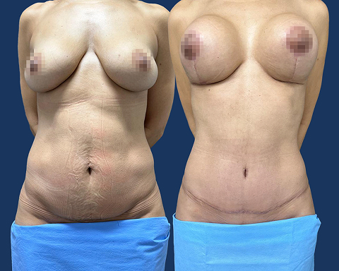 Mastopexia com Prótese e Abdominoplastia 06