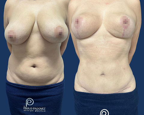 Mastopexia com Prótese e Lipoabdominoplastia 2