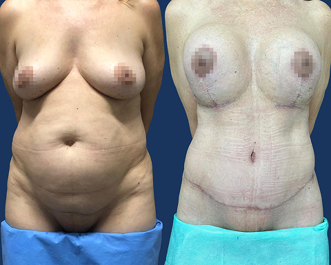 Mastopexia com Prótese e Lipoabdominoplastia 3