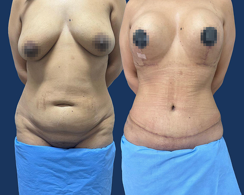 Mastopexia com Prótese e Lipoabdominoplastia
