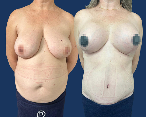 Mastopexia sem Prótese e Abdominoplastia 02