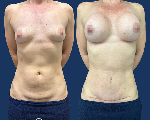 Mini Abdomen e Protese de Silicone